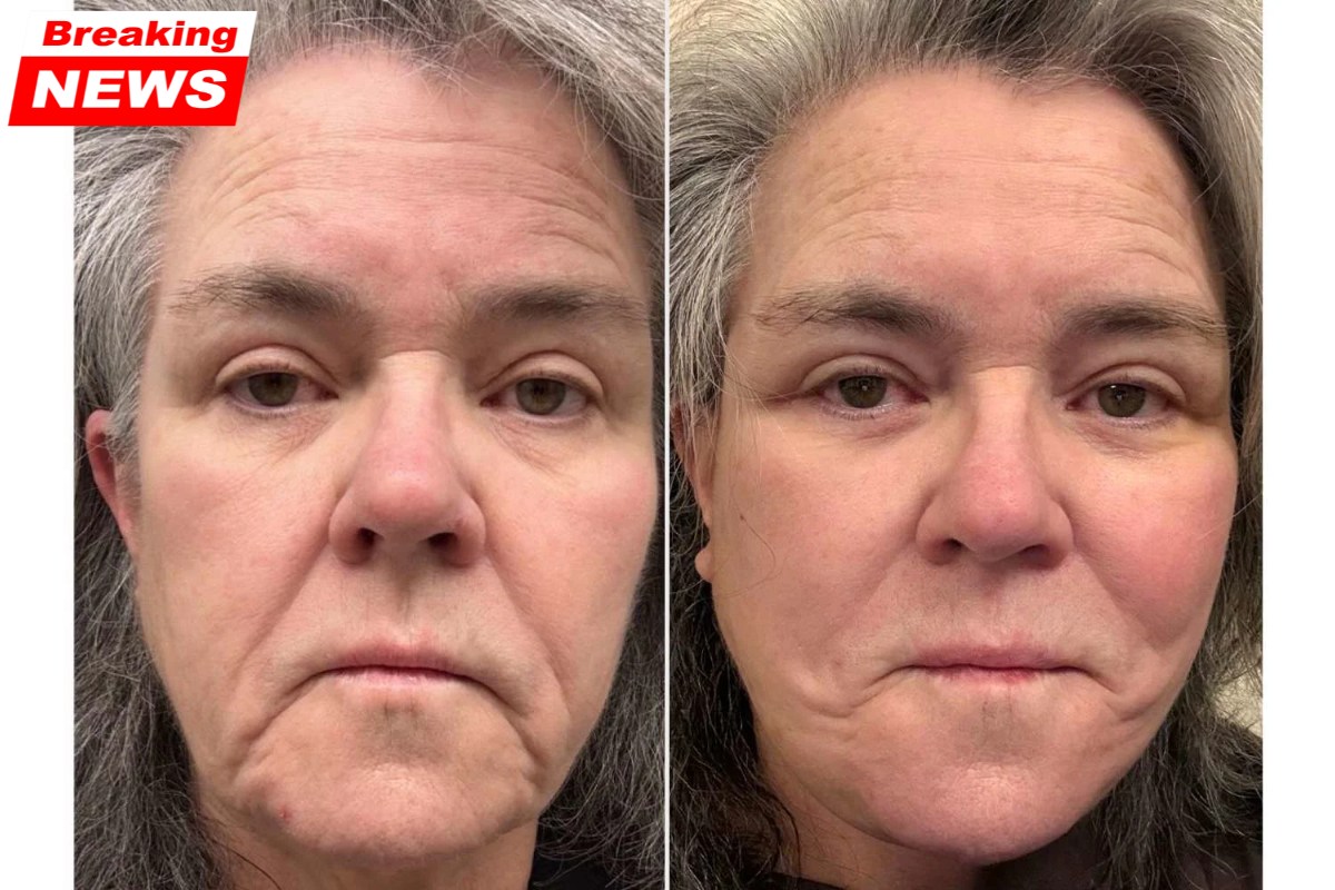 Rosie O'Donnell, 64, shares unfiltered before-and-after photos of her expensive facelift